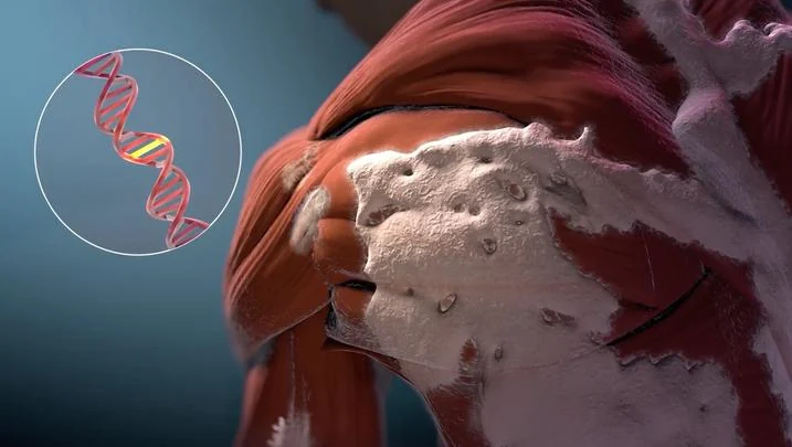 Medical illustration of tissue affected by abnormal bone formation